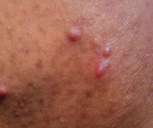 A closeup shot of cystic acne.