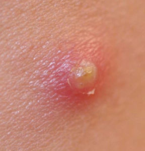 Closeup shot of a pustule.